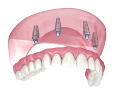 Four implant fixed full arch dental implants in Abilene, Texas