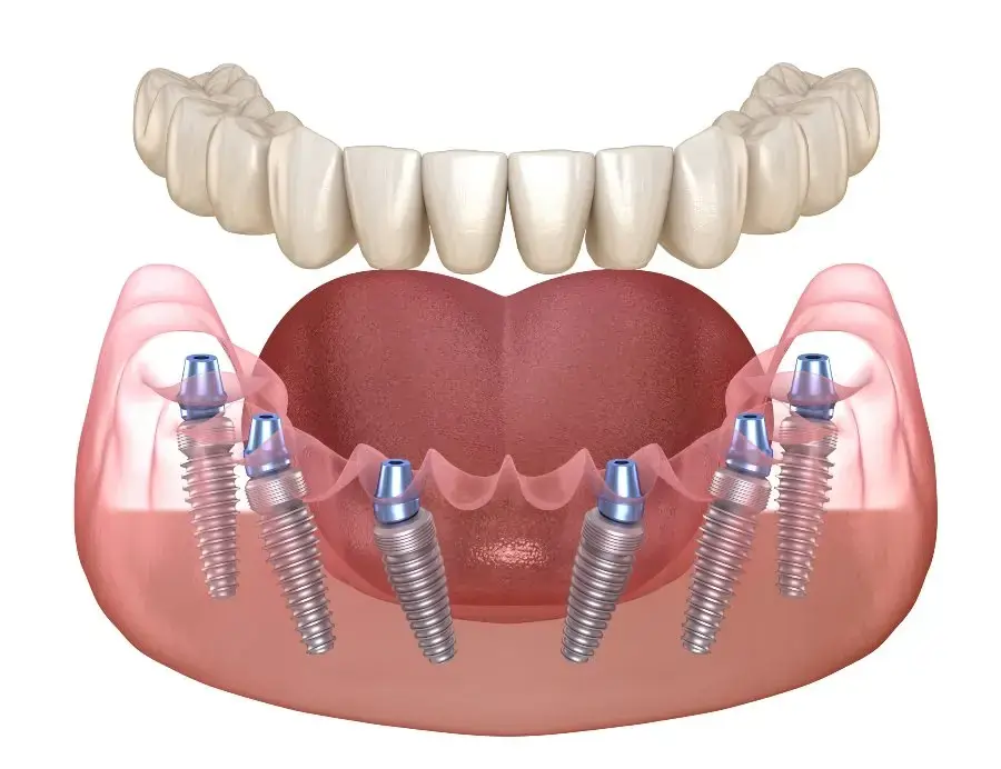 Fixed full arch implant dentures in Abilene, Texas