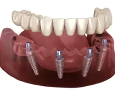 Permanent zirconia full arch dental implants in Abilene, Texas